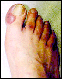 Superficial Frostbite Toes